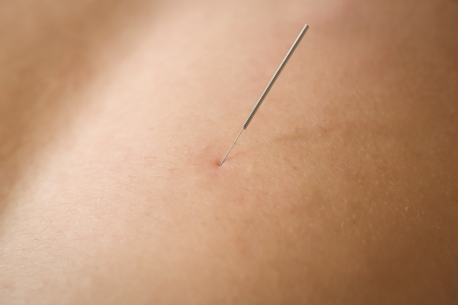 Positieve effecten van dry needling, ontdek ze hier!